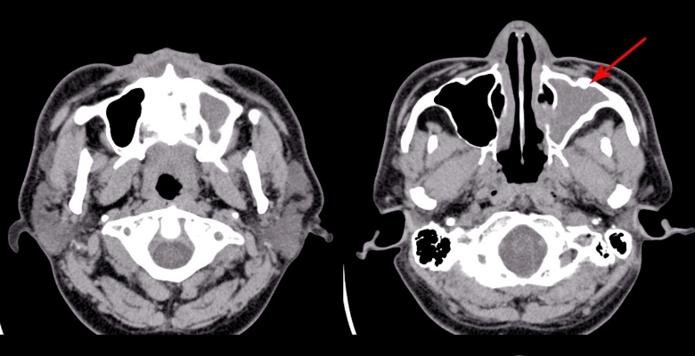Estudo português identifica fatores anatómicos associados à gravidade na rinossinusite aguda pediátrica